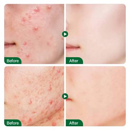 FORT Salicylic Acid Serum - Image 4