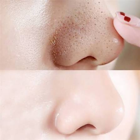10pcs Nose Blackhead Remover Strips Mask Skin Care - Image 2